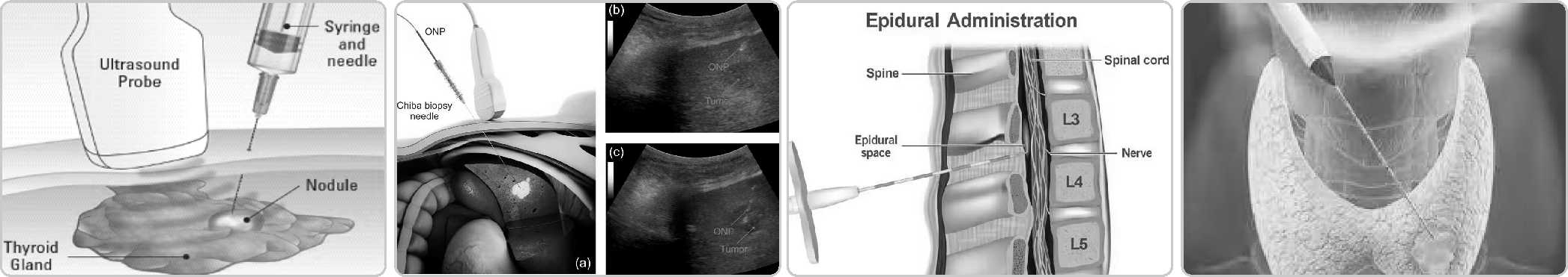 BIOPSY NEEDLE6.jpg