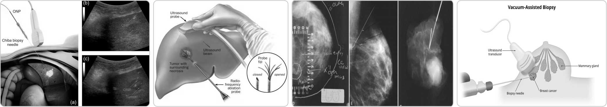 TISSUE MARKER3.jpg